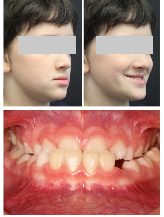 Caso Ortodonzia infantile Maino - Prima