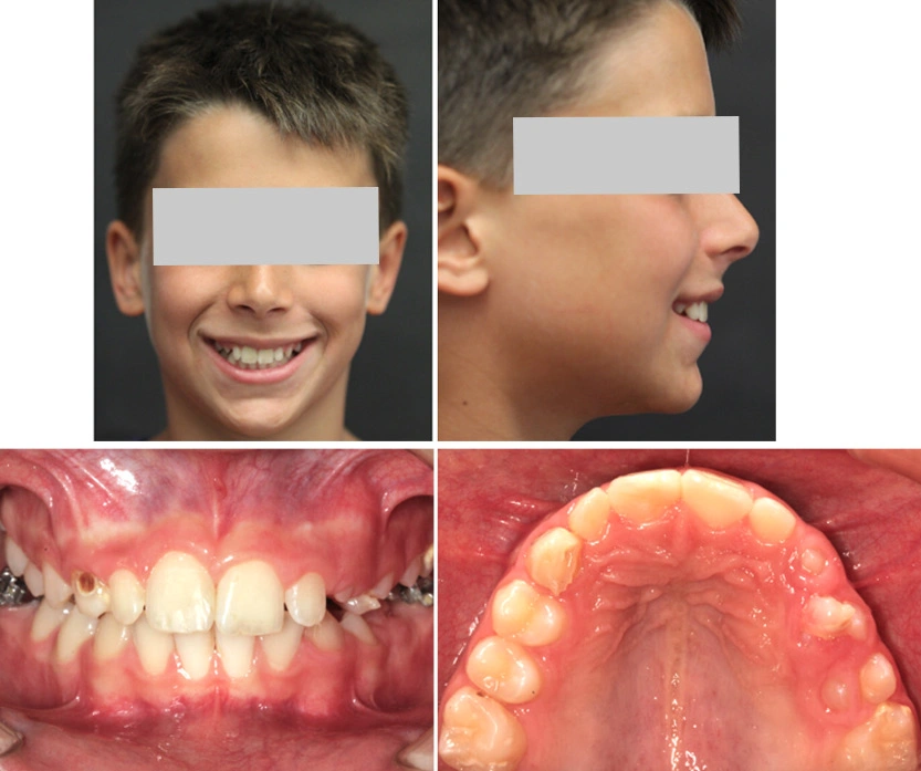 Caso Ortodonzia infantile Maino - Dopo