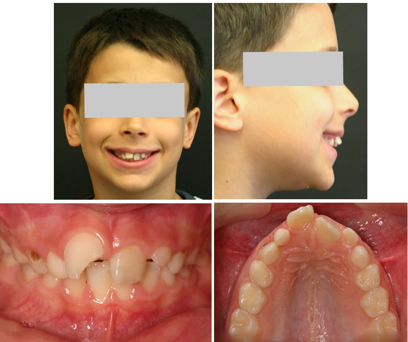 Caso Ortodonzia infantile Maino - Prima