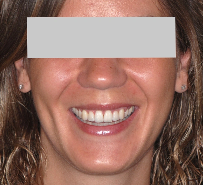 Ortodonzia linguale Maino - Dopo