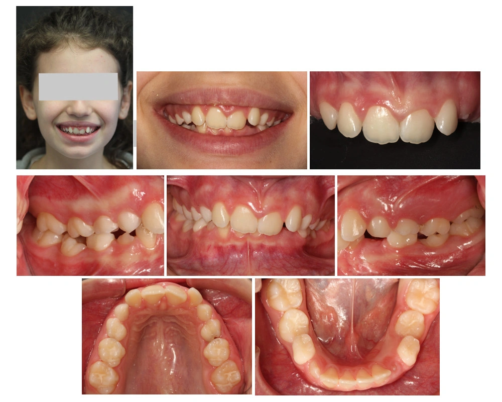 Ortodonzia teenage Maino - Prima