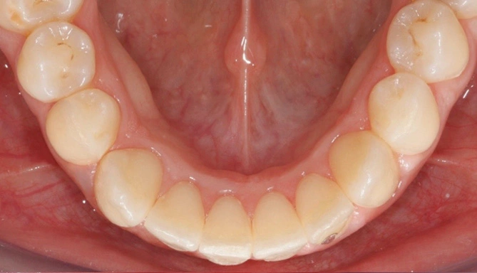 Ortodonzia linguale Maino - Dopo