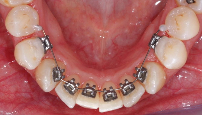 Ortodonzia linguale Maino - Durante