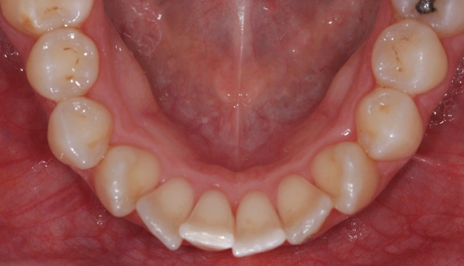 Ortodonzia linguale Maino - Prima