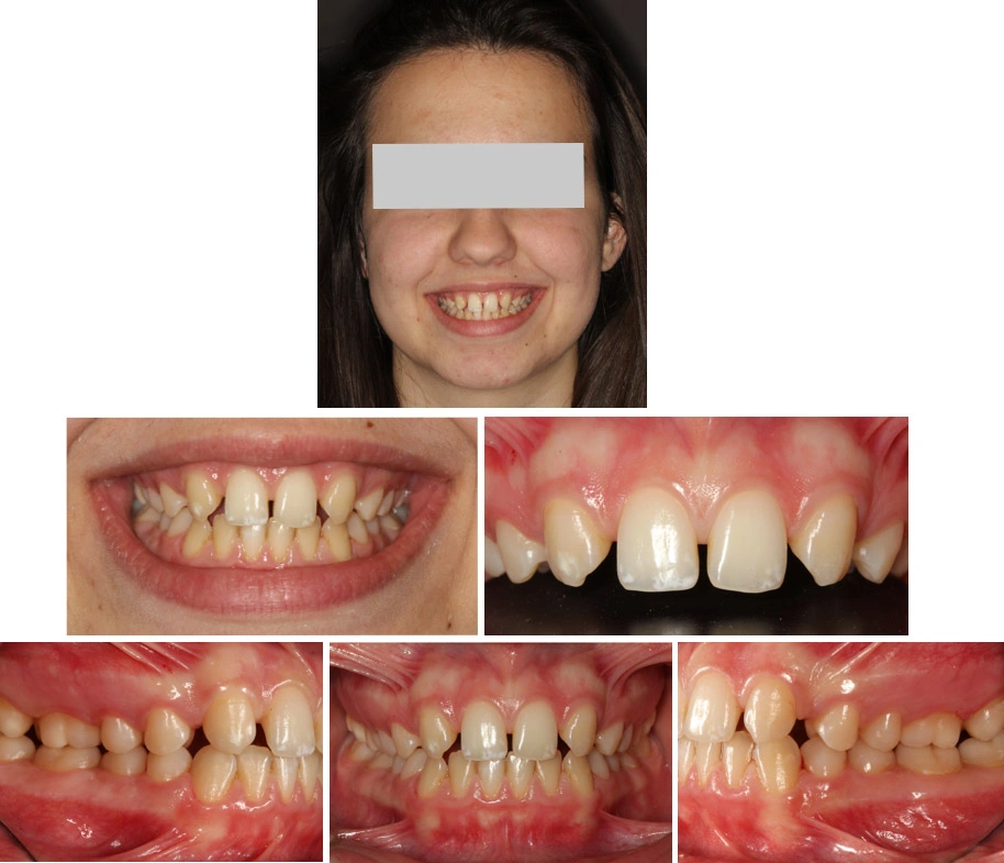 Ortodonzia teenage Maino - Prima
