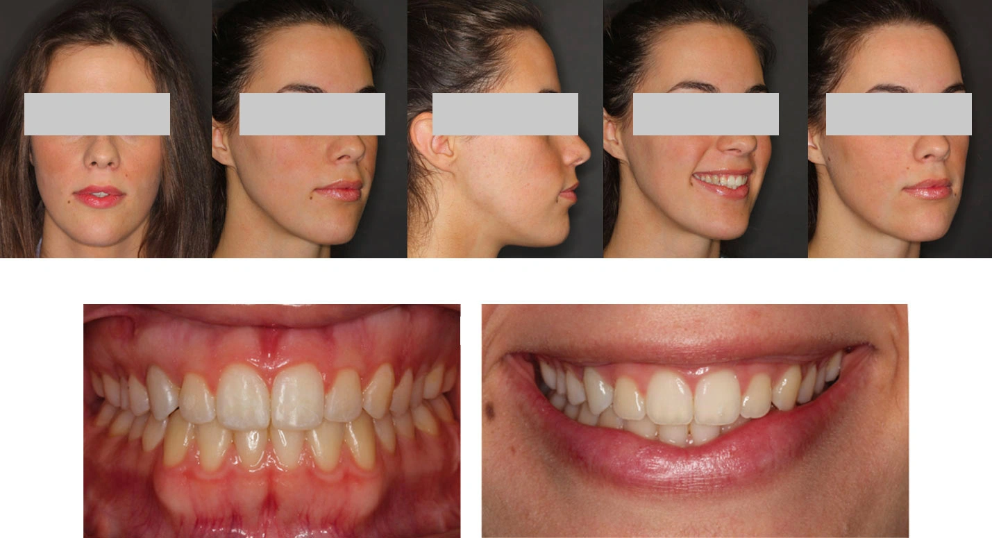 Trattamento ortodontico chirurgico Maino - Dopo