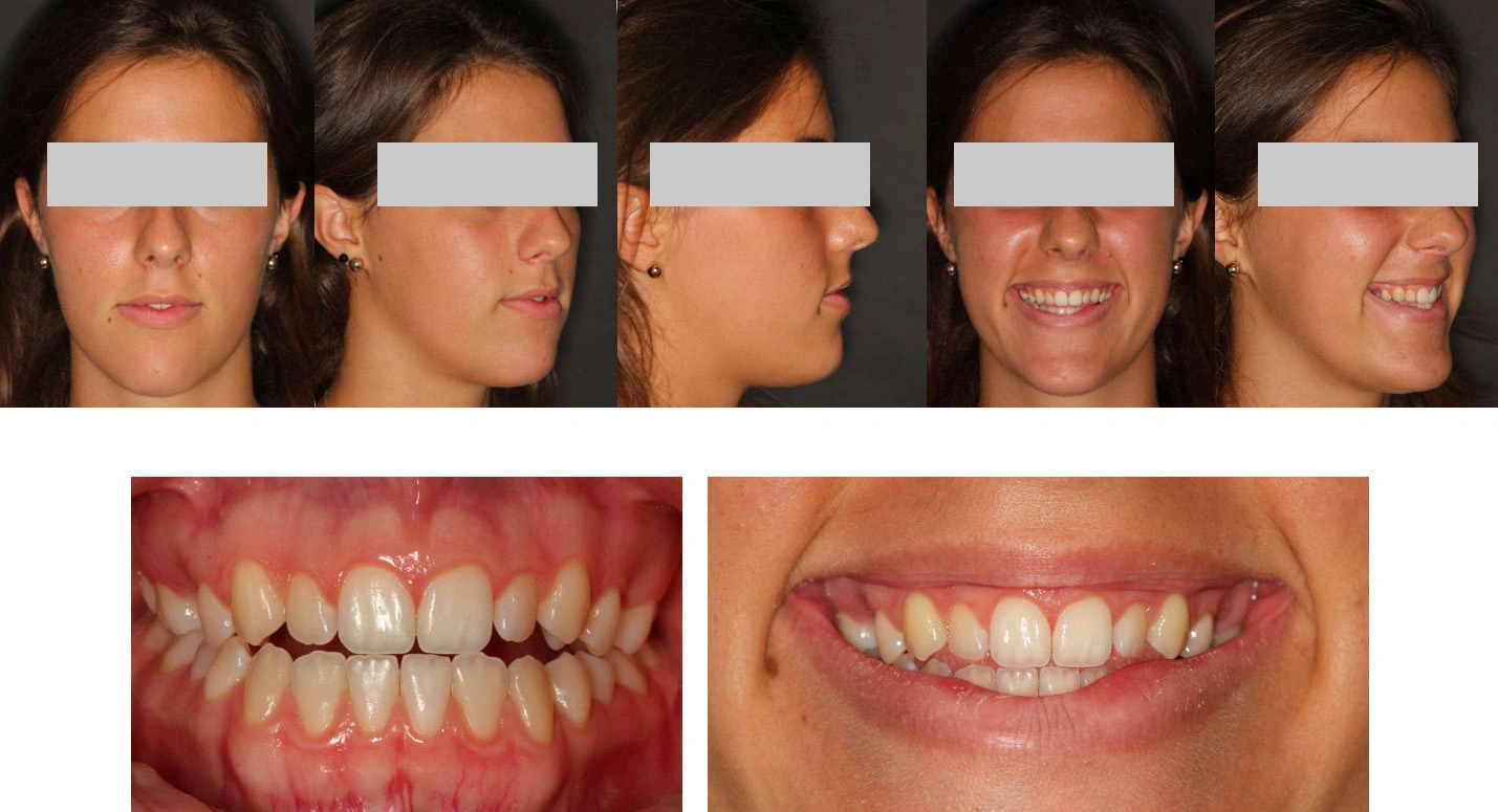 Trattamento ortodontico chirurgico Maino - Prima