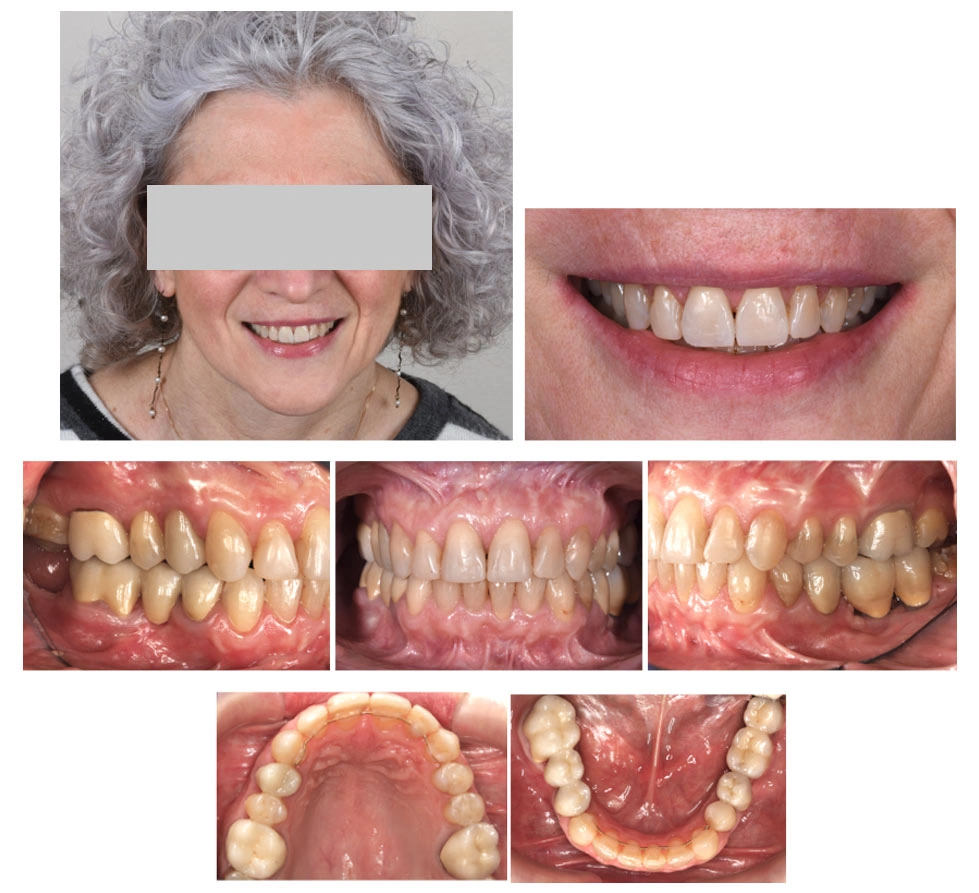 Trattamento ortodontico Maino - Dopo