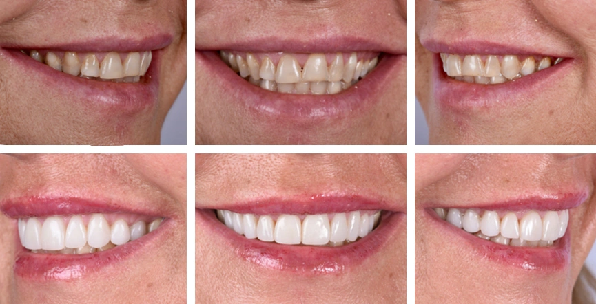 Faccette e Corone dentali - Smile Design